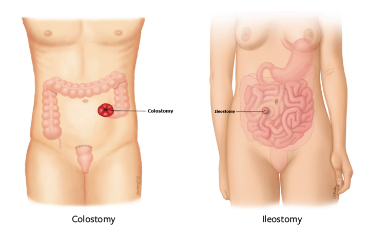Colorectal surgery two types of surgery diagrams