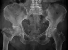 x-ray of right hip fracture