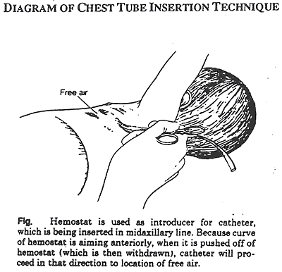 Chest tube insertion