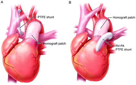 Stage 1 of single ventricle repair