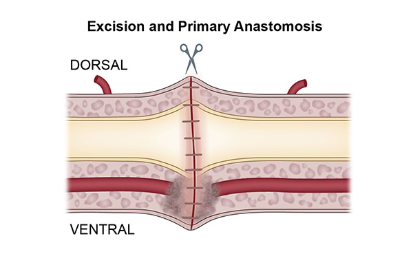 Excision and Primary Anastomosis