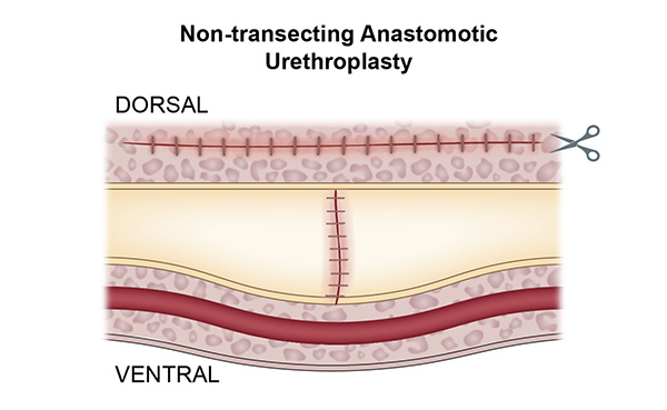 Non-transecting Anastomotic Urethroplasty