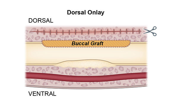 Dorsal Onlay