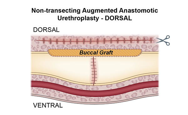 Non-transecting Augmented Anastomotic Urethroplasty Dorsal 