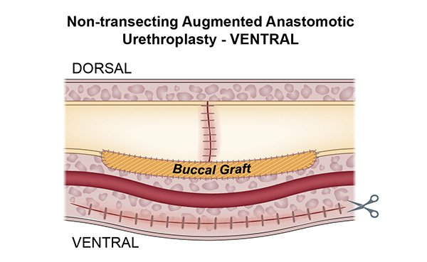 Non-transecting Augmented Anastomotic Urethroplasty Ventral