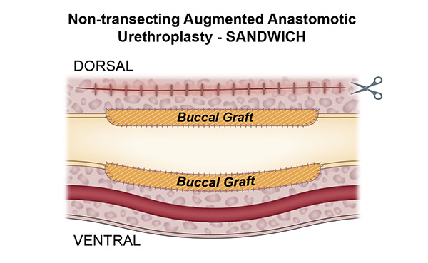 Non-transecting Augmented Anastomotic Urethroplasty Sandwich