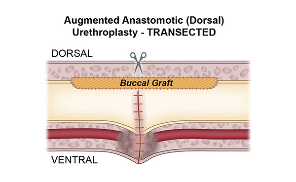 Augmented Anastomotic Dorsal Urethroplasty Transected 