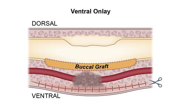Ventral Onlay 