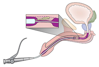 Direct visual internal urethrotomy