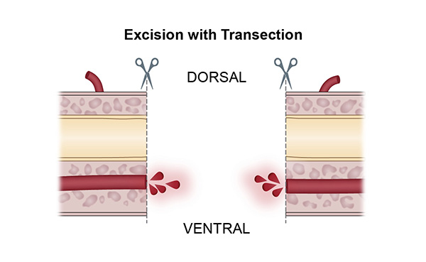 Excision with Transection