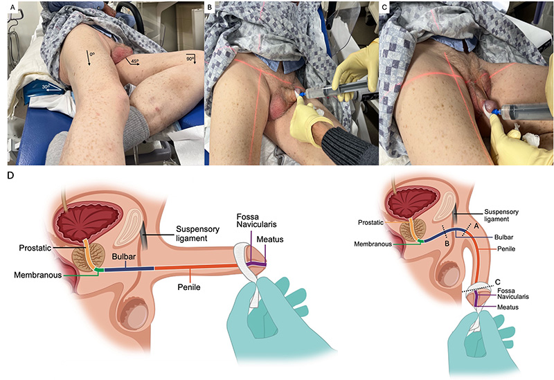 Retrograde Urethrogram Procedure