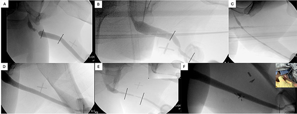 Retrograde Urethrogram X rays