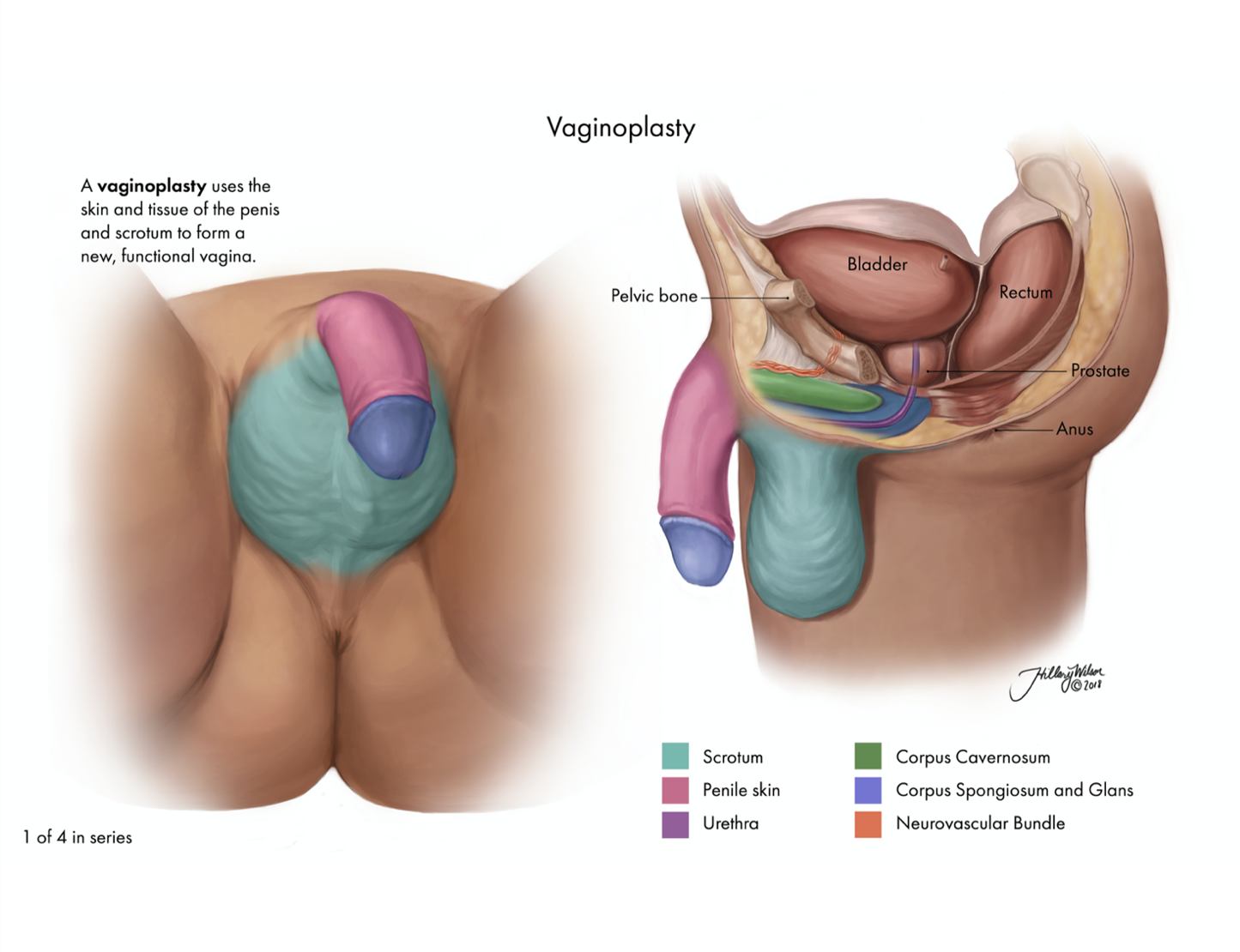 Vaginoplasty (1)