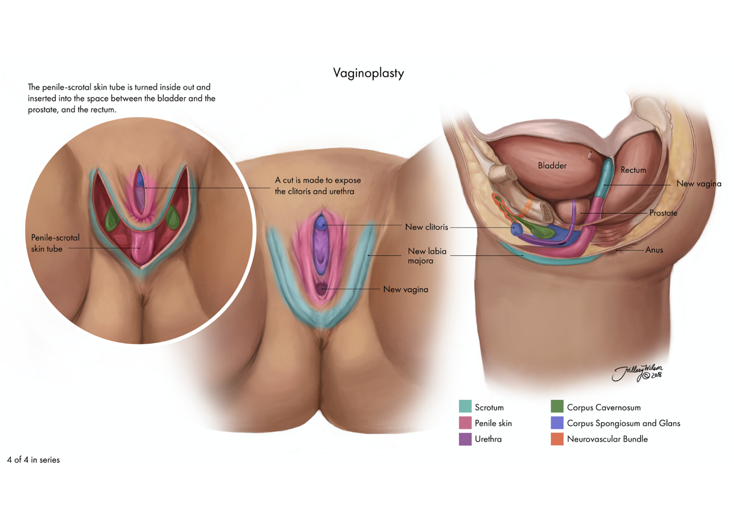Vaginoplasty 4
