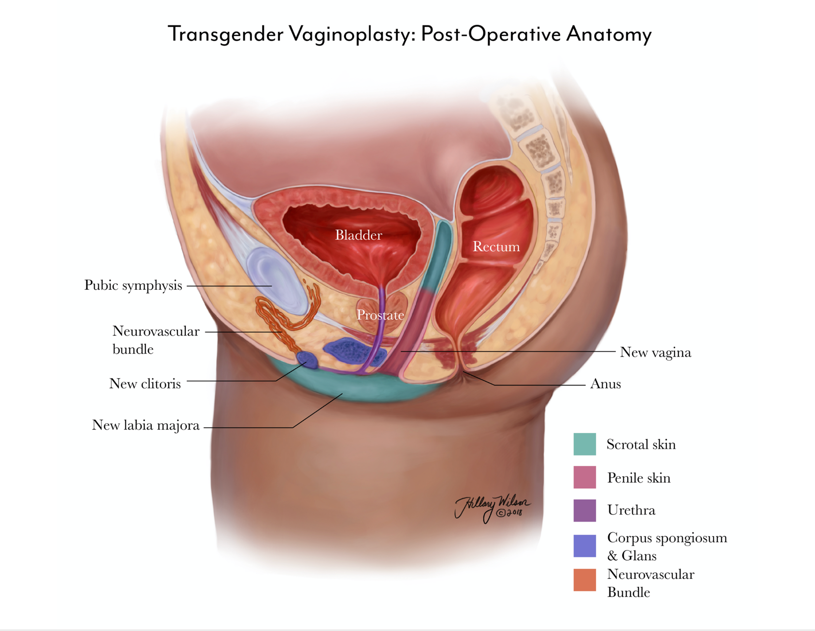 Vaginoplasty Postoperative Anatomy