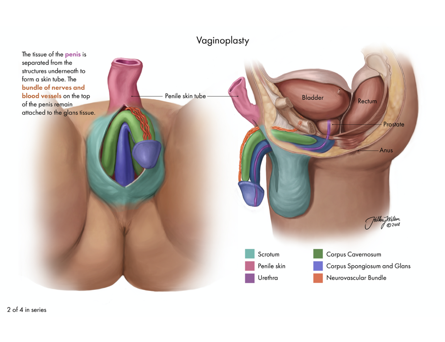 Vaginoplasty 2