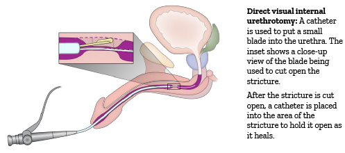 Direct visual internal urethrotomy (DVIU