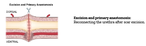 Excision and primary anastomosis
