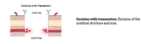 Excision with transition