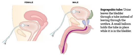 Suprapubic tube