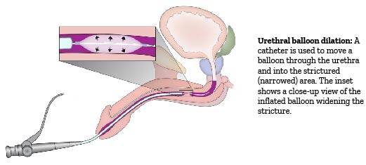Urethral balloon dilation