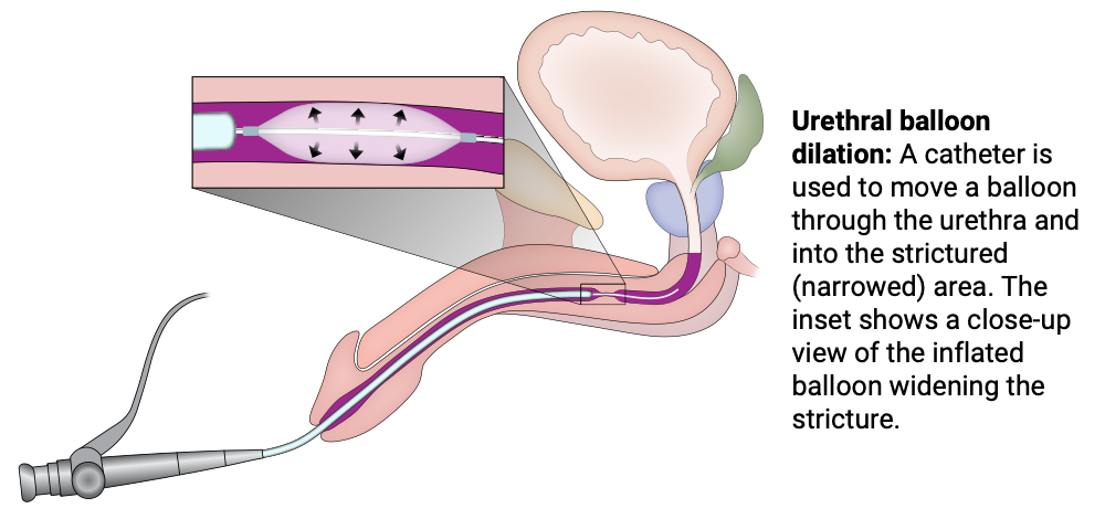 Urethral balloon dilation
