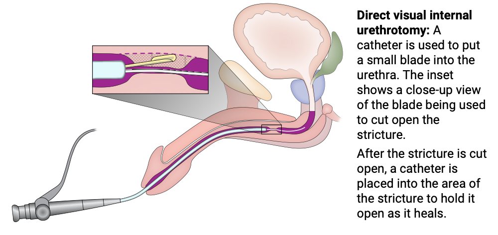 Direct visual internal urethrotomy