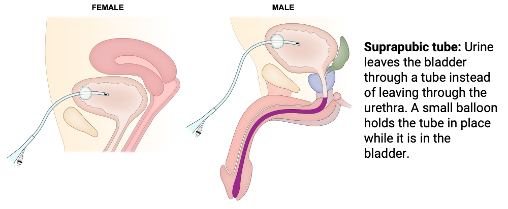 Suprapubic tube