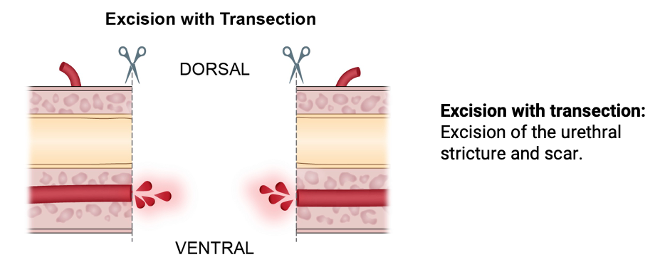 Excision with transection