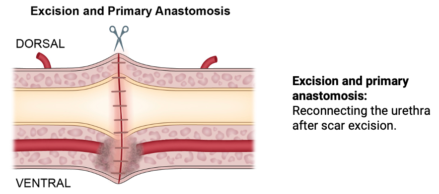 Excision and primary anastomsis