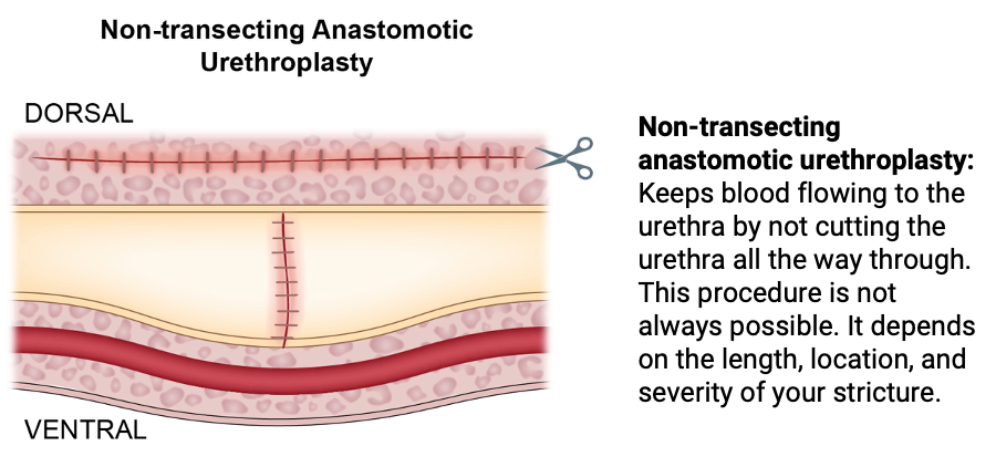 Nontransecting anastomotic urethroplasty