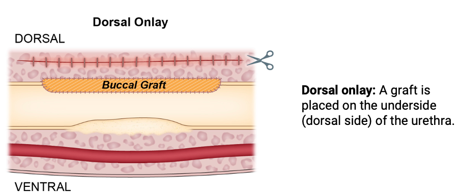 Dorsal onlay