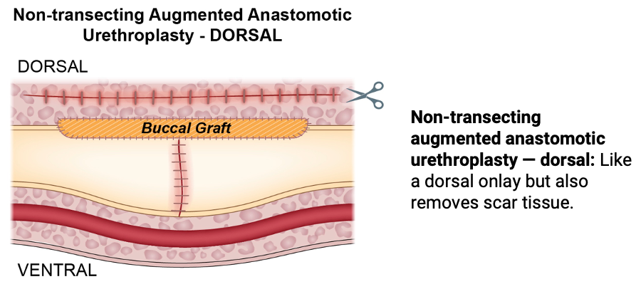 Nontransecting augmented anastomotic urethroplasty dorsal