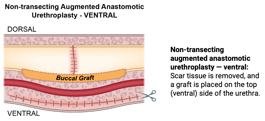 Nontransecting augmented anastomotic urethroplasty ventral