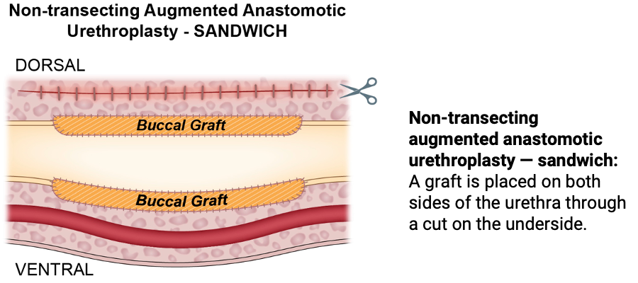 Nontransecting augmented anastomotic urethroplasty sandwich