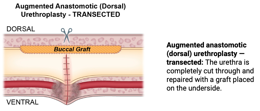 Augmented anastomotic dorsal urethroplasty transected