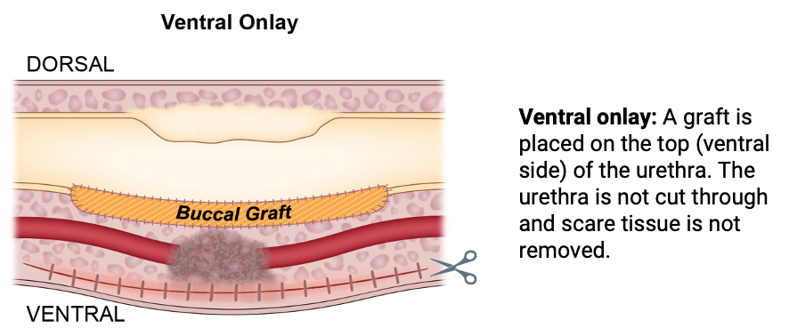 Ventral onlay