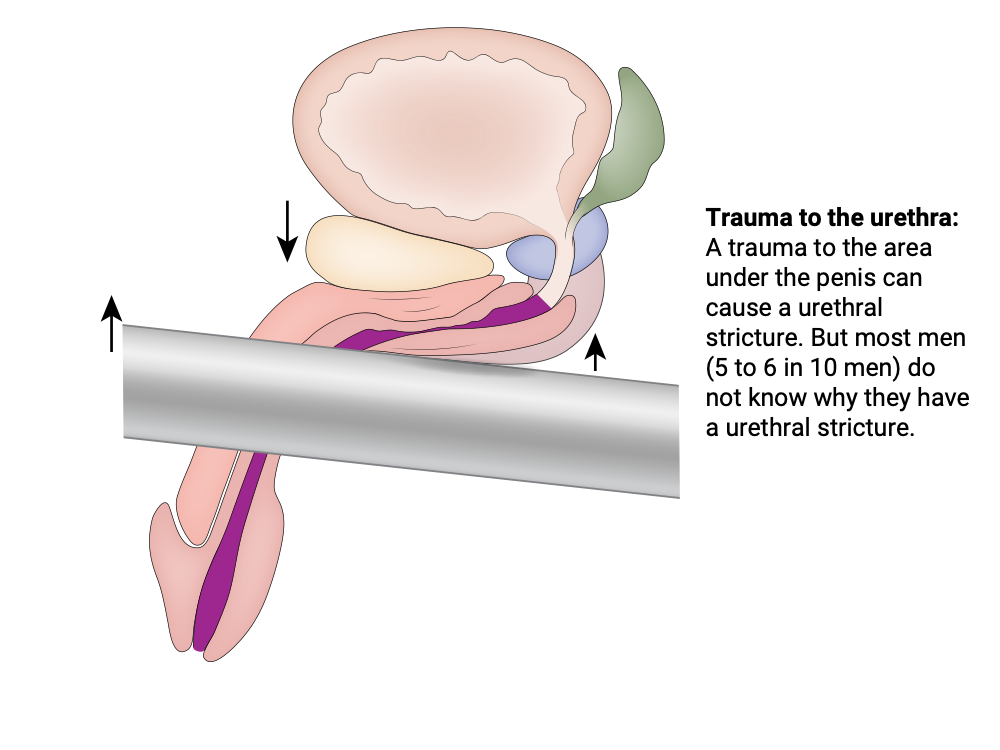Trauma to the urethra