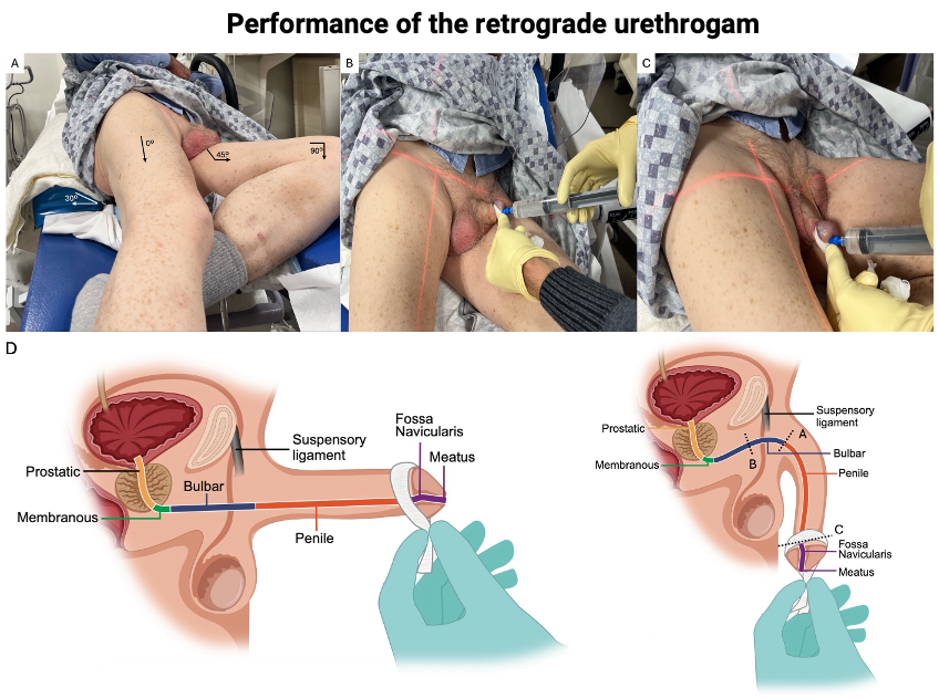 Performance of the retrograde urethrogam