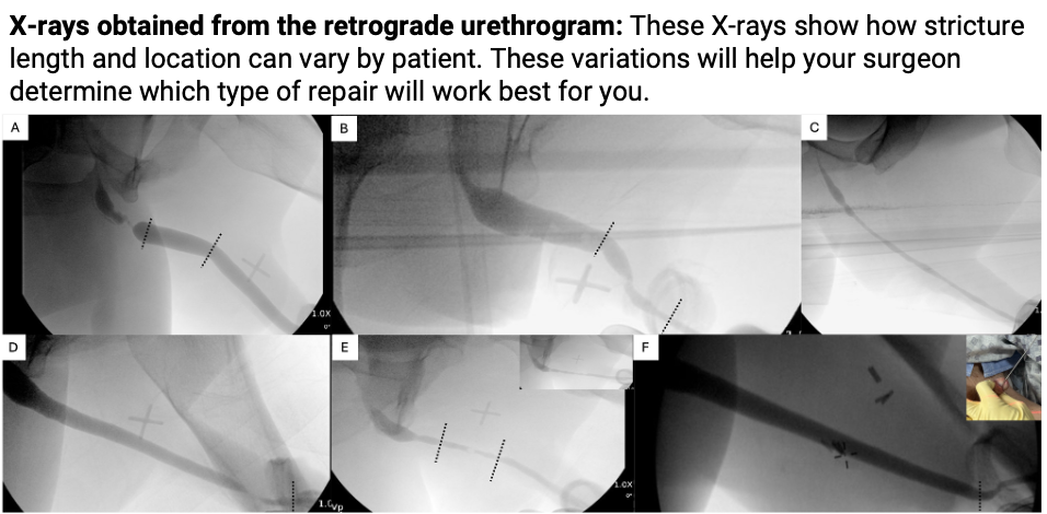 X-rays from the retrograde urethrogram
