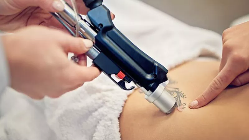 Stock image of laser tattoo removal