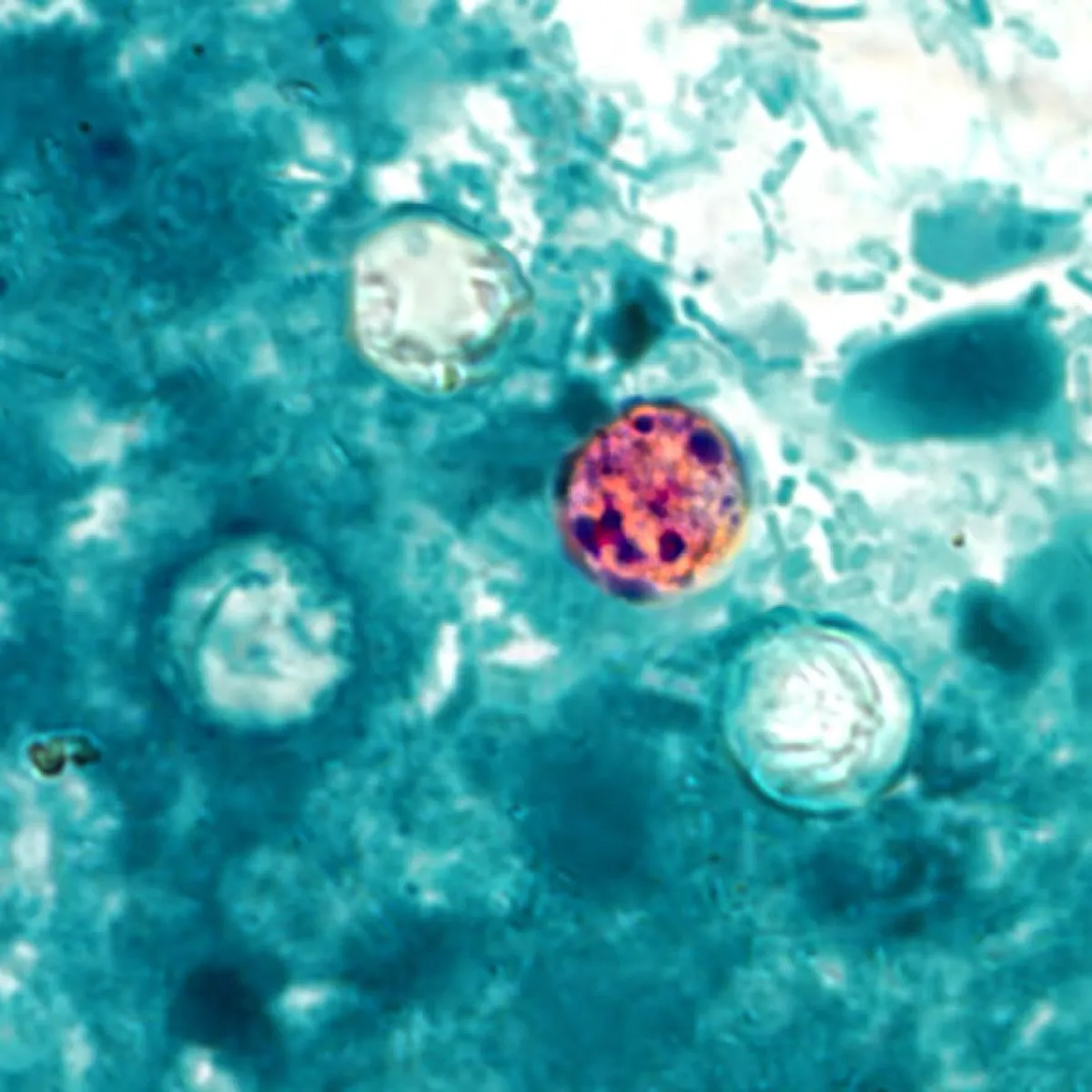 This photomicrograph of a fresh stool sample, which had been prepared using a 10% formalin solution, and stained with modified acid-fast stain, revealed the presence of four Cyclospora cayetanensis oocysts in the field of view. Compared to wet mount preparations, the oocysts are less perfectly round and have a wrinkled appearance due to this method of fixation. Most importantly, the staining is variable among the four oocysts.