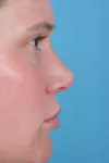 Side image of after nose surgery
