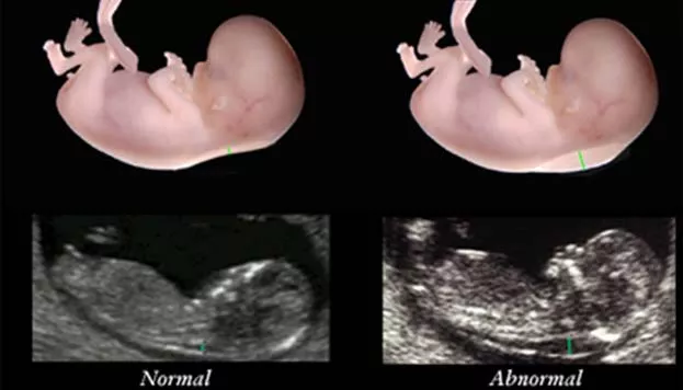 Nuchal Translucency Image