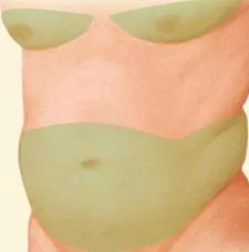 Liposuction torso green selection