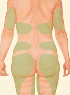 Liposuction backside green selection