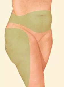 Liposuction middle and hip green selection