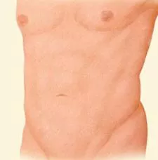 Liposuction torso section