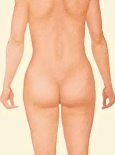 Liposuction backside
