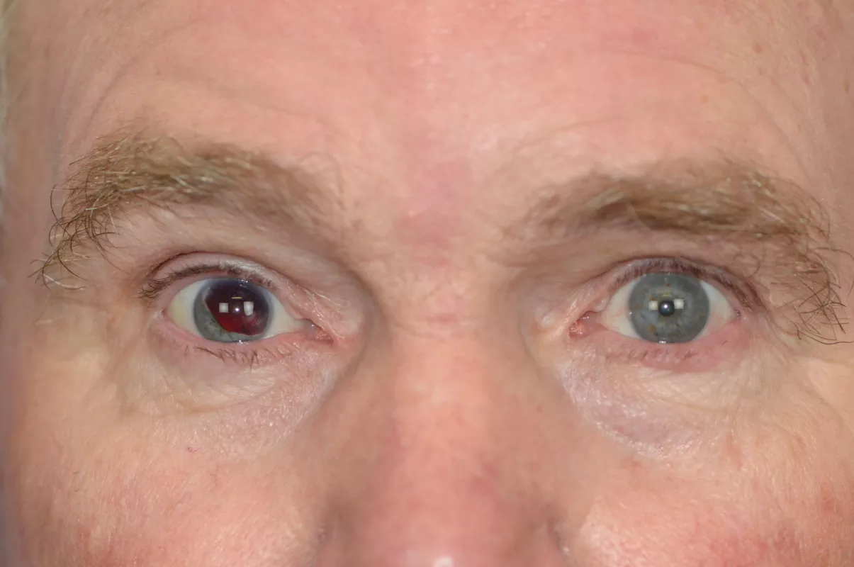 Larry Molyneux’s right eye injury